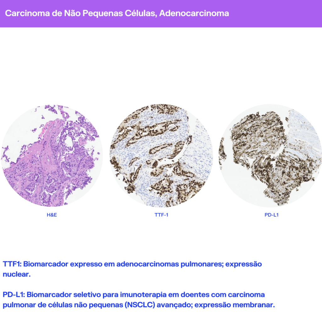 Cancro do Pulmão Padrões histomorfológicos