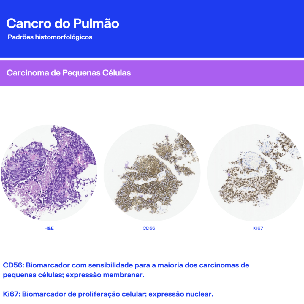 Cancro do Pulmão Padrões histomorfológicos