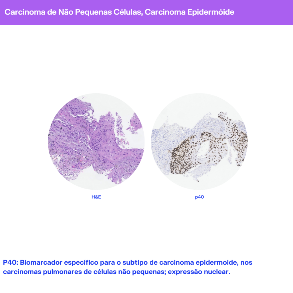 Cancro do Pulmão Padrões histomorfológicos